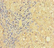 PRICKLE4 Antibody - Immunohistochemistry of paraffin-embedded human liver cancer using PRICKLE4 Antibody at dilution of 1:100