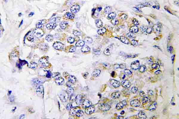 PRIM1 Antibody - IHC of PRIM1 (K413) pAb in paraffin-embedded human breast carcinoma tissue.