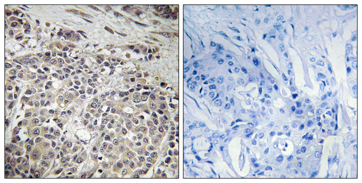 PRKAA1 / AMPK Alpha 1 Antibody - Immunohistochemistry analysis of paraffin-embedded human breast carcinoma tissue, using AMPK1 Antibody. The picture on the right is blocked with the synthesized peptide.