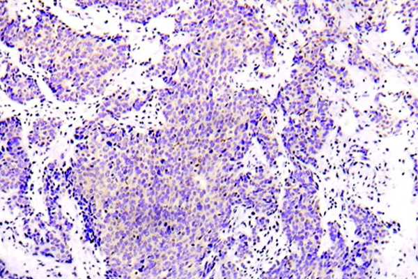 PRKAA1 / AMPK Alpha 1 Antibody - IHC of AMPK1/2 (R493) pAb in paraffin-embedded human lung adenocarcinoma tissue.