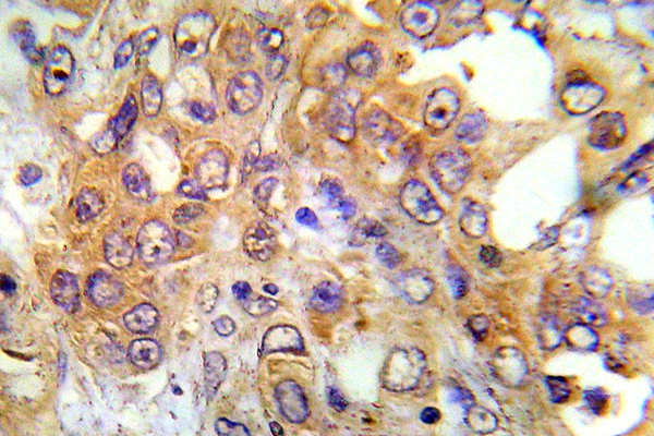 PRKAA1 / AMPK Alpha 1 Antibody - IHC of AMPK1 (N180) pAb in paraffin-embedded human breast carcinoma tissue.