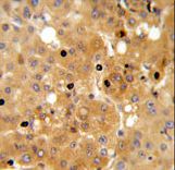 PRKAA1 / AMPK Alpha 1 Antibody - PRKAA1 Antibody IHC of formalin-fixed and paraffin-embedded human hepatocarcinoma followed by peroxidase-conjugated secondary antibody and DAB staining.