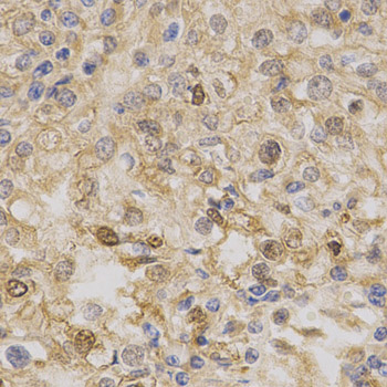 PRKAA1 / AMPK Alpha 1 Antibody - Immunohistochemistry of paraffin-embedded human liver cancer using PRKAA1 antibody at dilution of 1:200 (x400 lens).