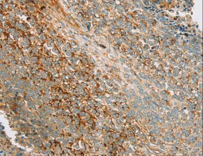 PRKAA1 / AMPK Alpha 1 Antibody - Immunohistochemistry of paraffin-embedded Human gastric cancer using PRKAA1 Polyclonal Antibody at dilution of 1:70.