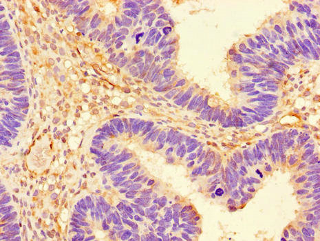 PRKAA1 / AMPK Alpha 1 Antibody - Immunohistochemistry of paraffin-embedded human ovarian cancer using PRKAA1 Antibody at dilution of 1:100