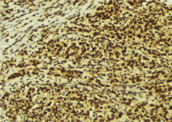 PRKAA1 / AMPK Alpha 1 Antibody - 1:100 staining human breast carcinoma tissue by IHC-P. The sample was formaldehyde fixed and a heat mediated antigen retrieval step in citrate buffer was performed. The sample was then blocked and incubated with the antibody for 1.5 hours at 22°C. An HRP conjugated goat anti-rabbit antibody was used as the secondary.