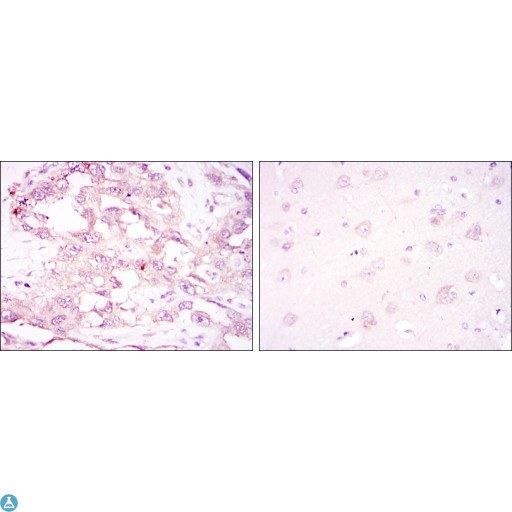 PRKAA1 / AMPK Alpha 1 Antibody - Immunohistochemistry (IHC) analysis of paraffin-embedded ovarian cancer (left) and brain tissues (right) with DAB staining using AMPKalpha1 Monoclonal Antibody.
