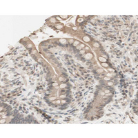 PRKAA1 / AMPK Alpha 1 Antibody - 1:200 staining human colon carcinoma tissue by IHC-P. The tissue was formaldehyde fixed and a heat mediated antigen retrieval step in citrate buffer was performed. The tissue was then blocked and incubated with the antibody for 1.5 hours at 22°C. An HRP conjugated goat anti-rabbit antibody was used as the secondary.