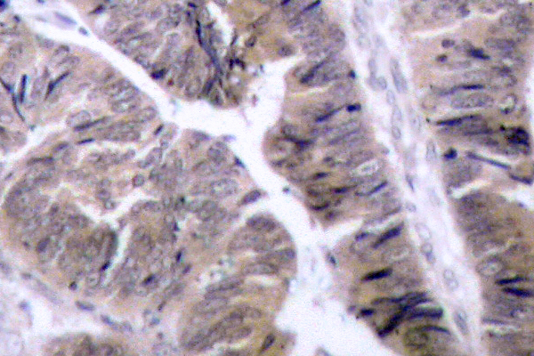 PRKAA1 / AMPK Alpha 1 Antibody - IHC of p-AMPK1 (S487) pAb in paraffin-embedded human colon carcinoma tissue.