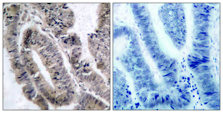 PRKAA1 / AMPK Alpha 1 Antibody - Immunohistochemistry analysis of paraffin-embedded human colon carcinoma, using AMPK1 (Phospho-Ser485) Antibody. The picture on the right is blocked with the phospho peptide.