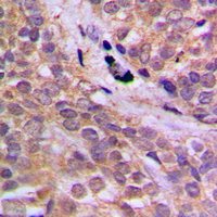 PRKAA1 / AMPK Alpha 1 Antibody - Immunohistochemical analysis of AMPK alpha 1 (pS496) staining in human breast cancer formalin fixed paraffin embedded tissue section. The section was pre-treated using heat mediated antigen retrieval with sodium citrate buffer (pH 6.0). The section was then incubated with the antibody at room temperature and detected using an HRP conjugated compact polymer system. DAB was used as the chromogen. The section was then counterstained with hematoxylin and mounted with DPX.