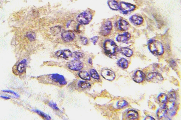PRKAA1 / AMPK Alpha 1 Antibody - IHC of p-AMPK1 (T174) pAb in paraffin-embedded human breast carcinoma tissue.