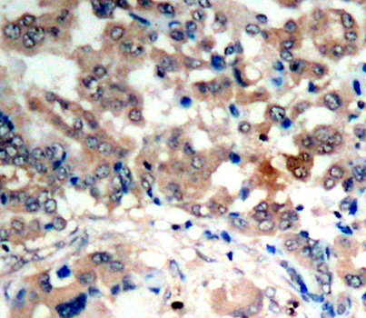 PRKAA1 / AMPK Alpha 1 Antibody - Immunohistochemical analysis of paraffin-embedded human lung carcinoma tissue.