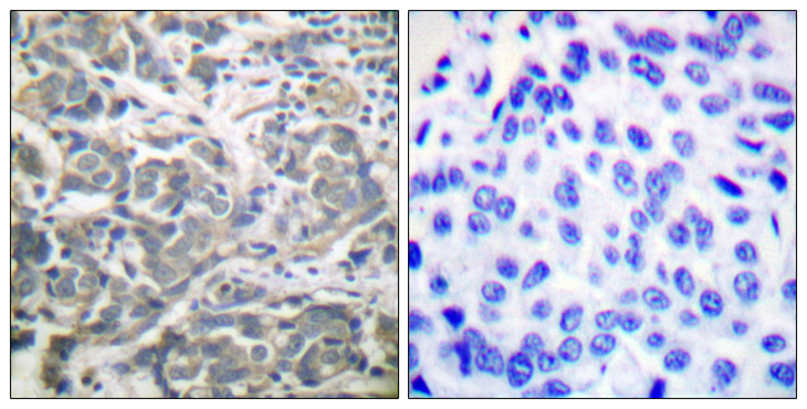 PRKAA1 + PRKAA2 Antibody - Immunohistochemistry analysis of paraffin-embedded human breast carcinoma tissue, using AMPK alpha Antibody. The picture on the right is blocked with the synthesized peptide.