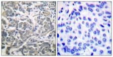 PRKAA1 + PRKAA2 Antibody - Immunohistochemistry analysis of paraffin-embedded human breast carcinoma tissue, using AMPK alpha Antibody. The picture on the right is blocked with the synthesized peptide.
