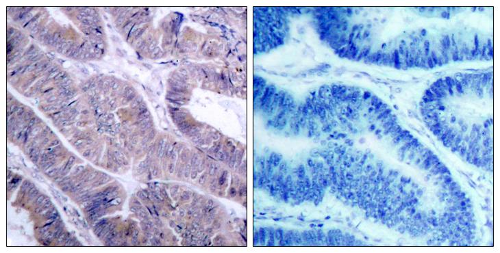 PRKAA1 + PRKAA2 Antibody - Immunohistochemical analysis of paraffin-embedded colon carcinoma, using AMPK1/AMPK2(Ab-485/491) Antibody. Left: Untreated; Right: Treated with synthesized peptide.