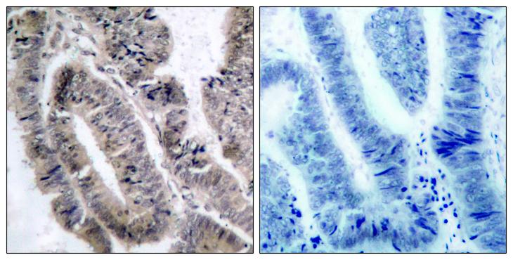 PRKAA1 + PRKAA2 Antibody - Immunohistochemical analysis of paraffin- embedded colon carcinoma, using AMPK1/AMPK2 (Phospho-Ser485/Ser491) Antibody. Left: Untreated; Right: Treated with synthesized phosphopeptide.
