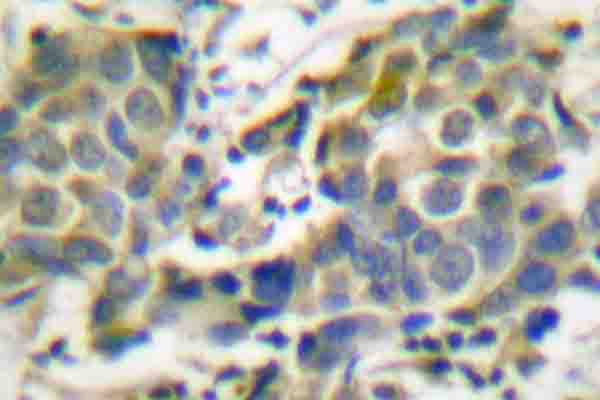 PRKAA1 + PRKAA2 Antibody - Immunohistochemistry (IHC) analysis of p-AMPK alpha 1/2 (T183/172) pAb in paraffin-embedded human breast cancer tissue.