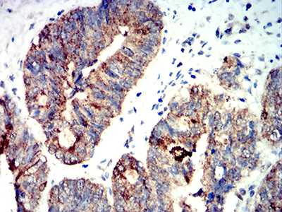 PRKAA2 / AMPK Alpha 2 Antibody - Immunohistochemical analysis of paraffin-embedded rectum cancer tissues using PRKAA2 mouse mAb with DAB staining.