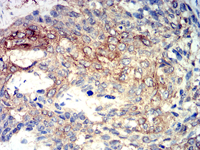 PRKAA2 / AMPK Alpha 2 Antibody - Immunohistochemical analysis of paraffin-embedded esophageal cancer tissues using PRKAA2 mouse mAb with DAB staining.