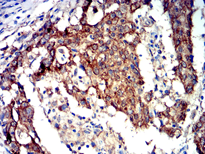 PRKAA2 / AMPK Alpha 2 Antibody - Immunohistochemical analysis of paraffin-embedded stomach cancer tissues using PRKAA2 mouse mAb with DAB staining.
