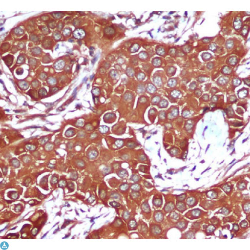 PRKAB1 / AMPK Beta 1 Antibody - Immunohistochemical analysis of paraffin-embedded Breast cancer using AMPK beta 1 mouse mAb (1:200 dilution).Antigen retrieval was performed by pressure cooking in citrate buffer (pH 6.0).