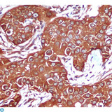 PRKAB1 / AMPK Beta 1 Antibody - Immunohistochemical analysis of paraffin-embedded Breast cancer using AMPK beta 1 mouse mAb (1:200 dilution).Antigen retrieval was performed by pressure cooking in citrate buffer (pH 6.0).