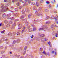 PRKAB1 / AMPK Beta 1 Antibody - Immunohistochemical analysis of AMPK beta 1 staining in human breast cancer formalin fixed paraffin embedded tissue section. The section was pre-treated using heat mediated antigen retrieval with sodium citrate buffer (pH 6.0). The section was then incubated with the antibody at room temperature and detected using an HRP conjugated compact polymer system. DAB was used as the chromogen. The section was then counterstained with hematoxylin and mounted with DPX.