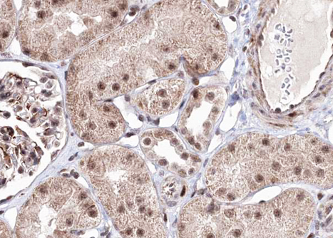 PRKAB1 / AMPK Beta 1 Antibody - 1:100 staining human kindey carcinoma tissue by IHC-P. The tissue was formaldehyde fixed and a heat mediated antigen retrieval step in citrate buffer was performed. The tissue was then blocked and incubated with the antibody for 1.5 hours at 22°C. An HRP conjugated goat anti-rabbit antibody was used as the secondary.