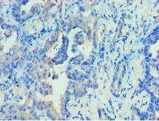 PRKAB2 / AMPK Beta 2 Antibody - Immunohistochemistry of paraffin-embedded human lung cancer using antibody at 1:100 dilution.