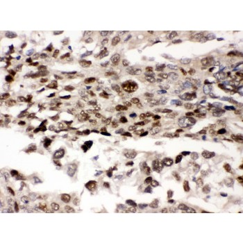PRKAB2 / AMPK Beta 2 Antibody - AMPK beta 2 antibody IHC-paraffin. IHC(P): Human Lung Cancer Tissue.