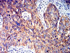 PRKAB2 / AMPK Beta 2 Antibody - Immunohistochemical analysis of paraffin-embedded cervical cancer tissues using PRKAB2 mouse mAb with DAB staining.
