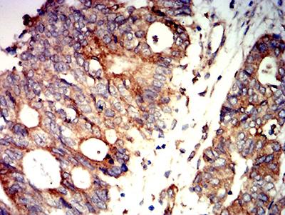 PRKAB2 / AMPK Beta 2 Antibody - Immunohistochemical analysis of paraffin-embedded rectum cancer tissues using PRKAB2 mouse mAb with DAB staining.