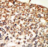 PRKACA + PRKACB Antibody - Formalin-fixed and paraffin-embedded human cancer tissue reacted with the primary antibody, which was peroxidase-conjugated to the secondary antibody, followed by AEC staining. This data demonstrates the use of this antibody for immunohistochemistry; clinical relevance has not been evaluated. BC = breast carcinoma; HC = hepatocarcinoma.