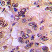 PRKACA + PRKACB Antibody - Immunohistochemical analysis of PKA C alpha/beta staining in human breast cancer formalin fixed paraffin embedded tissue section. The section was pre-treated using heat mediated antigen retrieval with sodium citrate buffer (pH 6.0). The section was then incubated with the antibody at room temperature and detected using an HRP conjugated compact polymer system. DAB was used as the chromogen. The section was then counterstained with hematoxylin and mounted with DPX.