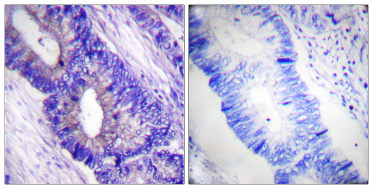 PRKACA + PRKACB Antibody - Immunohistochemistry analysis of paraffin-embedded human colon carcinoma, using PKA CAT (Phospho-Thr197) Antibody. The picture on the right is blocked with the phospho peptide.