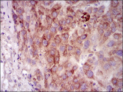 PRKACG Antibody - IHC of paraffin-embedded liver cancer tissues using PRKACG mouse monoclonal antibody with DAB staining.
