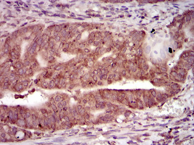 PRKACG Antibody - IHC of paraffin-embedded rectum cancer tissues using PRKACG mouse monoclonal antibody with DAB staining.