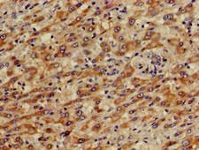 PRKACG Antibody - Immunohistochemistry of paraffin-embedded human liver cancer using PRKACG Antibody at dilution of 1:100