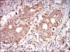 PRKAG1 / AMPK Gamma 1 Antibody - IHC of paraffin-embedded cervical cancer tissues using PRKAG1 mouse monoclonal antibody with DAB staining.