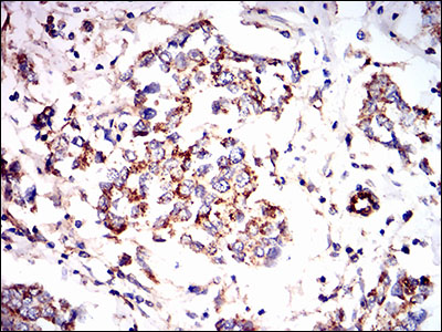 PRKAG1 / AMPK Gamma 1 Antibody - IHC of paraffin-embedded breast cancer tissues using PRKAG1 mouse monoclonal antibody with DAB staining.