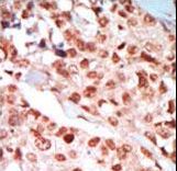 PRKAG1 / AMPK Gamma 1 Antibody - Formalin-fixed and paraffin-embedded human cancer tissue reacted with the primary antibody, which was peroxidase-conjugated to the secondary antibody, followed by DAB staining. This data demonstrates the use of this antibody for immunohistochemistry; clinical relevance has not been evaluated. BC = breast carcinoma; HC = hepatocarcinoma.