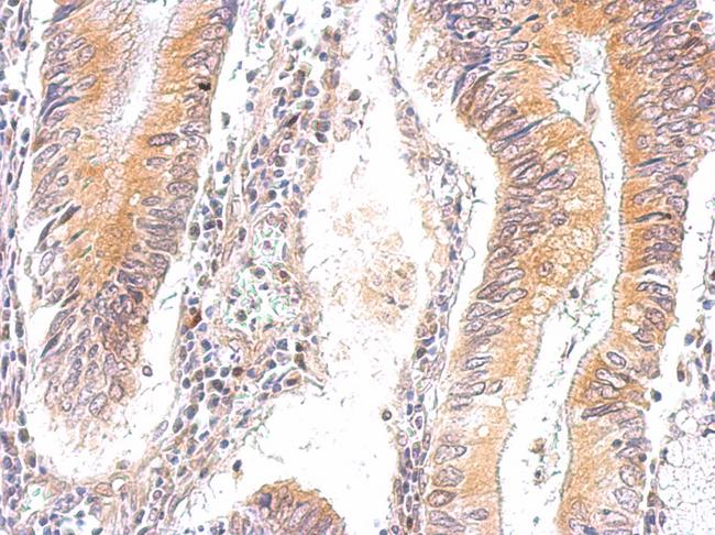 PRKAG2 / AMPK Gamma 2 Antibody - AMPK gamma 2 antibody detects PRKAG2 protein at cytosol on gastric carcinoma by immunohistochemical analysis. Sample: Paraffin-embedded gastric carcinoma tissue. AMPK gamma 2 antibody dilution:1:500.