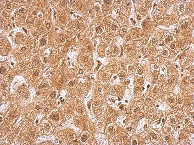 PRKAG2 / AMPK Gamma 2 Antibody - AMPK gamma 2 antibody [C2C3], C-term detects PRKAG2 protein at nucleus and cytosol on hepatoma by immunohistochemical analysis. Sample: Paraffin-embedded hepatoma. AMPK gamma 2 antibody [C2C3], C-term dilution:1:500.