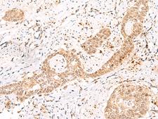 PRKAG2 / AMPK Gamma 2 Antibody - Immunohistochemistry of paraffin-embedded Human esophagus cancer tissue  using PRKAG2 Polyclonal Antibody at dilution of 1:55(×200)