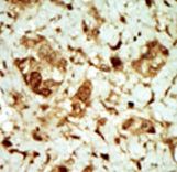PRKAG3 / AMPK Gamma 3 Antibody - Formalin-fixed and paraffin-embedded human cancer tissue reacted with the primary antibody, which was peroxidase-conjugated to the secondary antibody, followed by DAB staining. This data demonstrates the use of this antibody for immunohistochemistry; clinical relevance has not been evaluated. BC = breast carcinoma; HC = hepatocarcinoma.