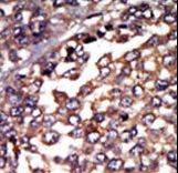 PRKAR1A Antibody - Formalin-fixed and paraffin-embedded human cancer tissue reacted with the primary antibody, which was peroxidase-conjugated to the secondary antibody, followed by AEC staining. This data demonstrates the use of this antibody for immunohistochemistry; clinical relevance has not been evaluated. BC = breast carcinoma; HC = hepatocarcinoma.