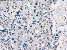 PRKAR1A Antibody - Immunohistochemical staining of paraffin-embedded Adenocarcinoma of breast tissue using anti-PRKAR1A mouse monoclonal antibody. (Dilution 1:50).