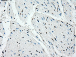 PRKAR1A Antibody - Immunohistochemical staining of paraffin-embedded Carcinoma of bladder tissue using anti-PRKAR1A mouse monoclonal antibody. (Dilution 1:50).