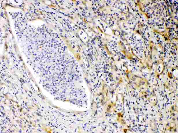 PRKAR1A Antibody - PRKAR1A was detected in paraffin-embedded sections of human intestinal cancer tissues using rabbit anti- PRKAR1A Antigen Affinity purified polyclonal antibody